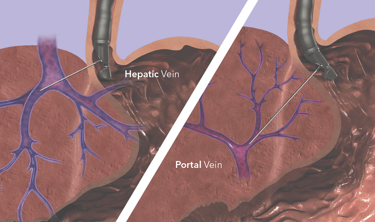 EchoTip Insight Vein Illustration